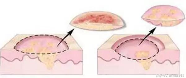 浅层放射治疗疤痕疙瘩,浅层x射线治疗疤痕疙瘩费用