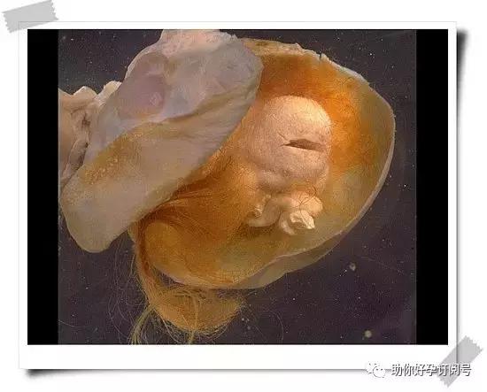 畸胎瘤八大超声征象,畸胎瘤肿瘤五项