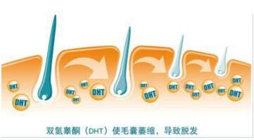 济南遗传性脱发植发效果如何,脂溢性脱发遗传性脱发植发有用吗