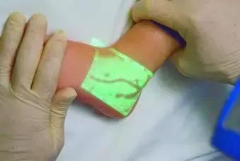 这个黑科技能照亮你的血管，让护士好好地给你扎针！