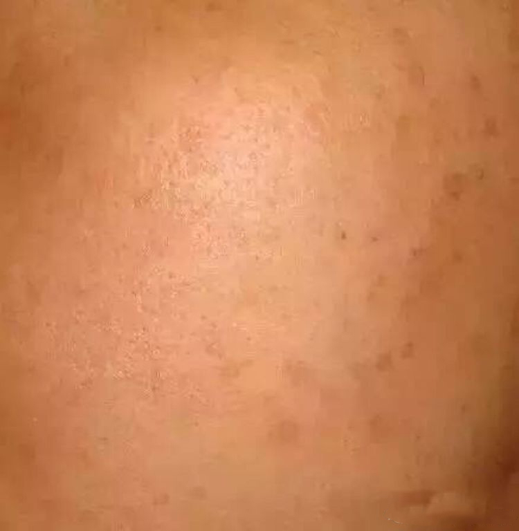 女人长斑肤质差教你一招轻松淡斑,刘艳青美白淡斑