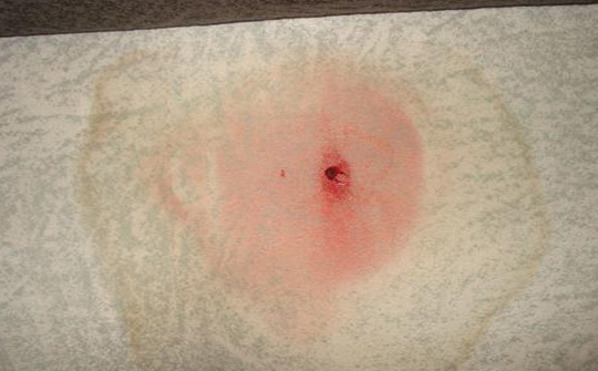 出现这一症状要当心可能是慢性肾炎的早期症状