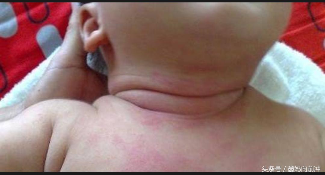 湿疹和痱子的鉴别方法 (湿疹和热痱子怎么辨别)