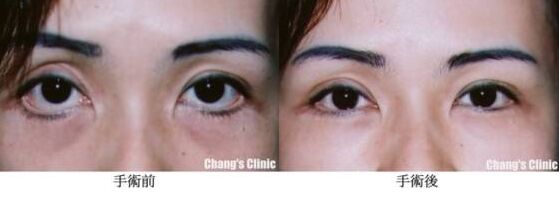 上眼睑轻微外翻有办法治疗吗,眼睑外翻治疗方案