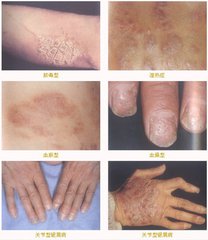 世界最好的治疗牛皮癣药,治疗牛皮癣的瑞士进口药叫什么