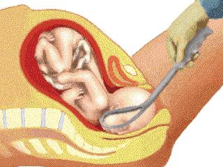 第6版妇产科护理学,第71课