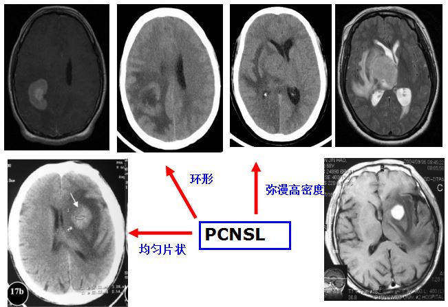 医学干货：瘤样炎性脱髓鞘病与胶质瘤、PCNSL临床、影像鉴别