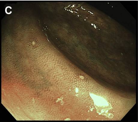 腹泻的不同类型及病例,腹泻的不同原因及现象