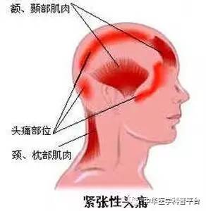 有什么办法治疗紧张性头痛,中医治疗紧张性头痛的方法