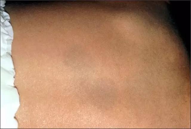 宝宝身上很多痣,宝宝身上的痣有母痣
