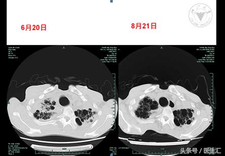 晨起胸闷气短心跳加速,晨起胸闷气短呼吸困难是怎么了