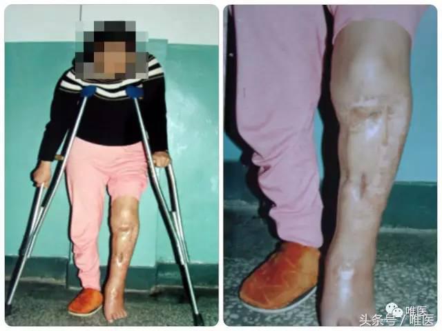 胫骨平台骨缺损处理,胫骨下端部分骨缺损如何植骨