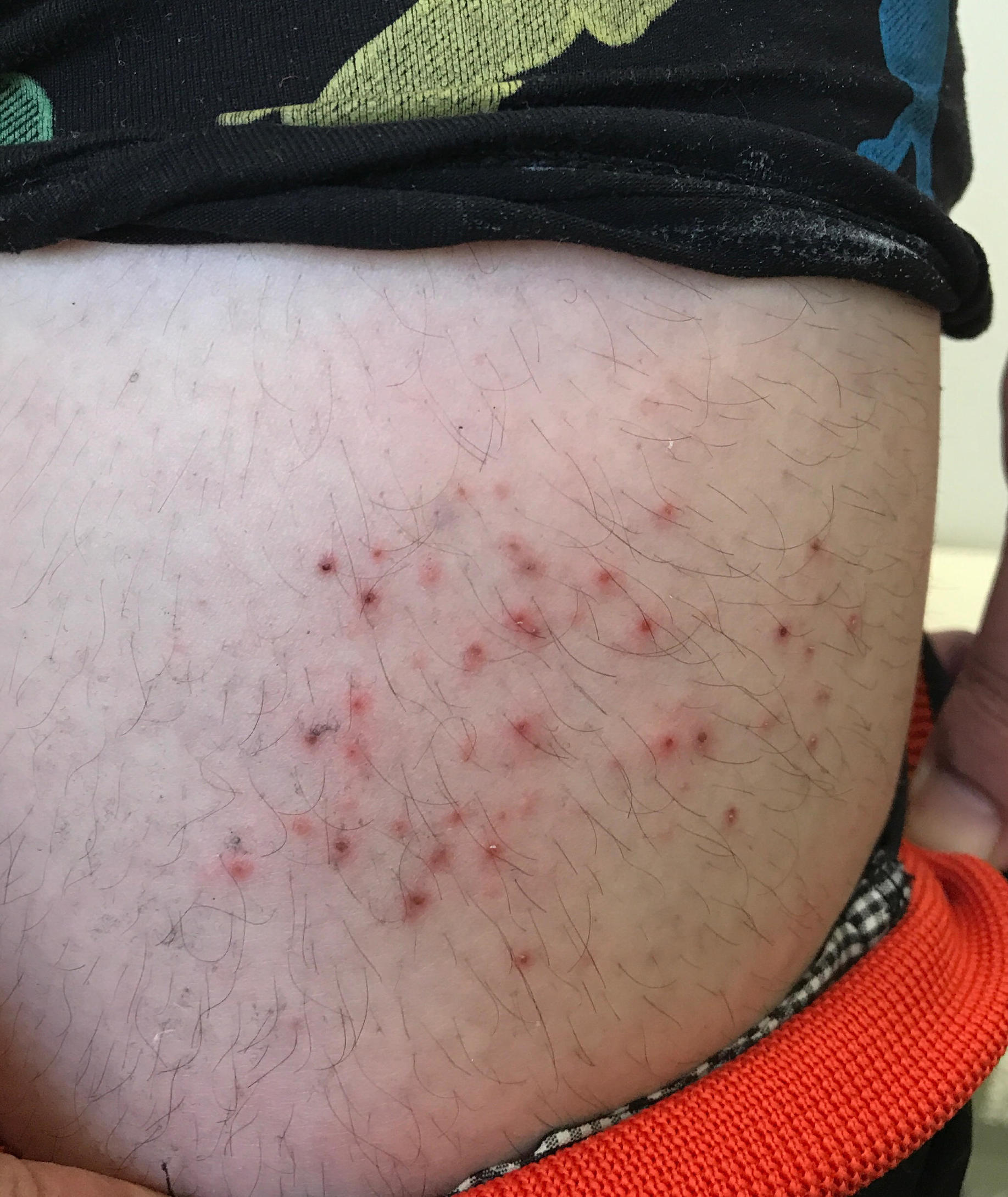 肚子上起湿疹怎么治,肚子上有湿疹怎么解决