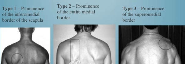纠正肩胛骨突出的办法视频,矫正翼状肩胛骨的正确方法