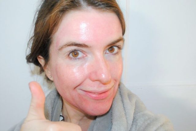 祛痘祛闭口粉刺黑头,如何有效的祛痘去黑头去闭口