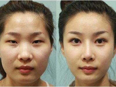 眼睛整形开眼角,眼睛变大的方法手术