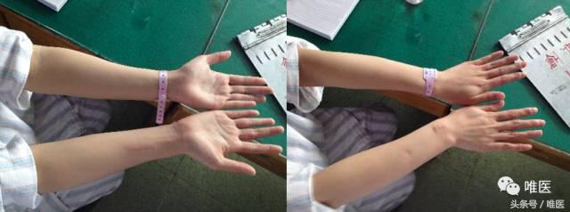 肱骨髓内钉的手术体位,肱骨髓内钉术后康复恢复步骤