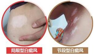 白癜风临床经典30问答