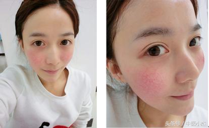 专家讲述：面部*血丝红**的正确治愈方法，找对病因是关键