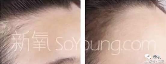 杨幂发际线还会回归吗,杨幂发际线秃到后脑勺