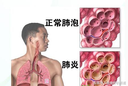 你咳什么样的痰，我就知道你得的是什么病！