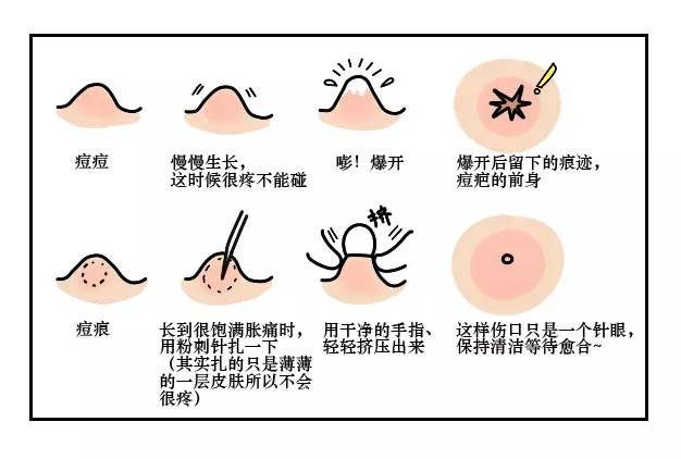 第二天要穿吊带如何解决背后痘痘,后背有痘痘穿吊带的急救办法