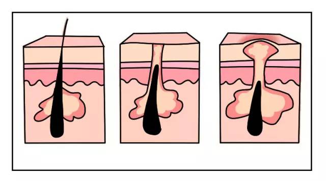 背上痘痘夏天怎么穿吊带,背后长痘痘怎么穿小吊带