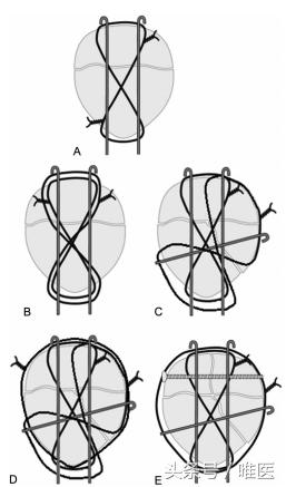 骨科前沿｜新式张力带固定术治疗复杂髌骨骨折，骨折骨性愈合率高达81.5%