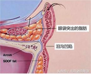 泪沟和眼袋有什么区别？预防及治疗方法有哪些？