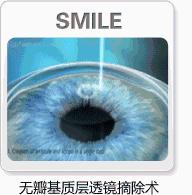 全飞秒smile3.0和全飞秒手术一样吗,smile全飞秒和smart全飞秒的区别