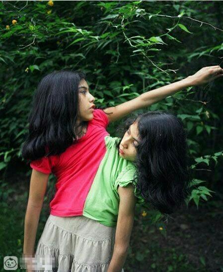 双胞胎连体人生活,连体双胞胎的难以置信的生活