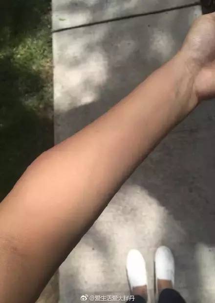 外国人被蚊子咬了后背长了个大包,被蚊子咬后留下硬疙瘩图片