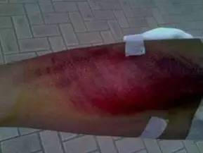 运动防护和急救小知识,运动损伤的急救措施有哪些