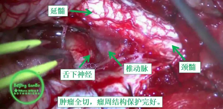 喝水容易呛是怎么回事是肺癌,老人喝水容易呛咳怎么办