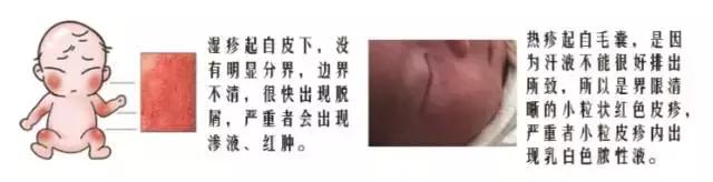 宝宝治疗痱子最快速有效的方法,痱子的处理