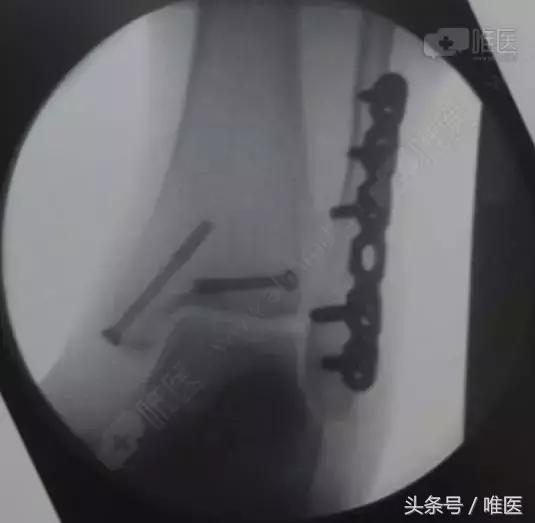 脚踝十年前扭伤现在肿痛什么原因,脚踝扭伤肿痛多少个小时可以擦药