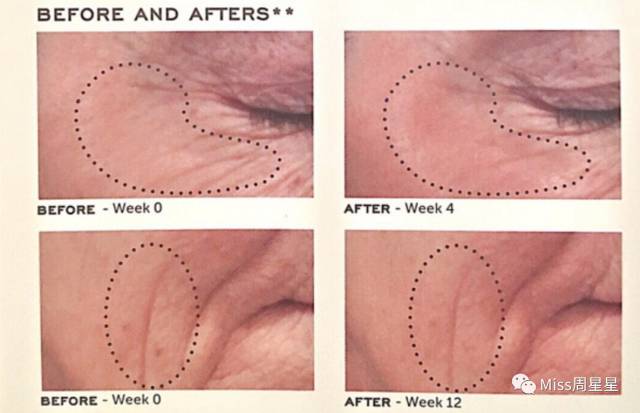 iluminagelaser美容仪,紧致去皱美白美容仪