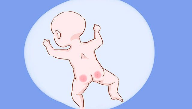 宝宝红屁股是不是纸尿裤过敏,娃穿尿不湿突然起疹子