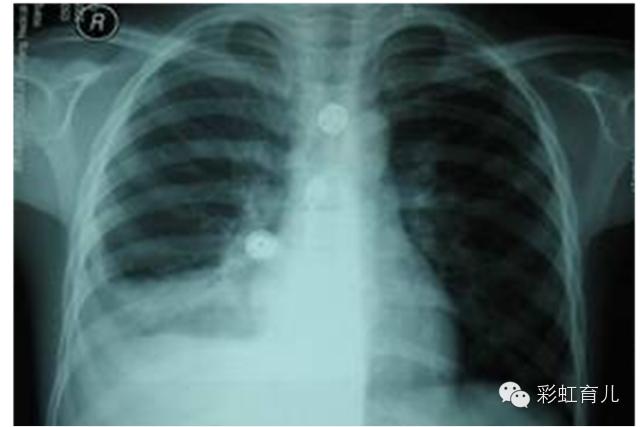 宝宝易出汗咳嗽,宝宝感冒气喘咳嗽怎么治疗最有效