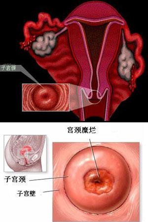 子宫糜烂不治可以吗,子宫糜烂会自己痊愈吗