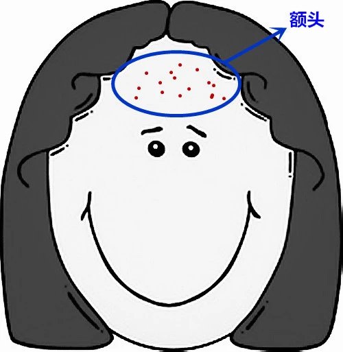 面部痘痘严重程度检测,痘痘面部分析