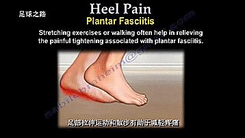 足跟痛的症状及表现,足跟痛最常见病因