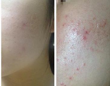 下巴痘痘反复长不停如何正确祛痘,下巴老是长痘痘怎么调理身体啊