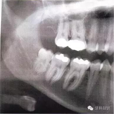 口腔拔牙图片,口腔拔牙麻醉多久消退