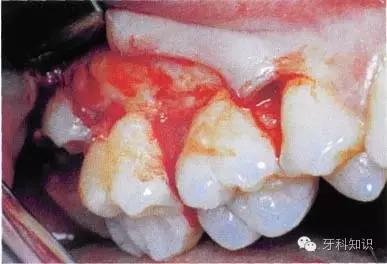 口腔拔牙图片,口腔拔牙麻醉多久消退