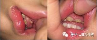 牙龈长脓包怎么办需要吃药吗,牙龈长脓包了吃什么药好