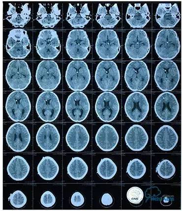 脑静脉窦狭窄做支架危险吗,静脉窦狭窄做支架后多久恢复