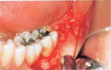口腔拔牙图片,口腔拔牙麻醉多久消退