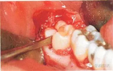 口腔拔牙图片,口腔拔牙麻醉多久消退