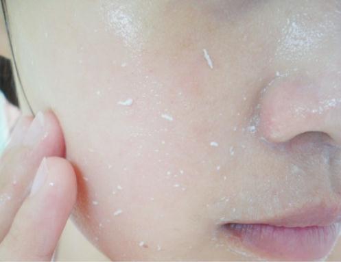 闭口粉刺做什么皮肤管理,皮肤管理粉刺